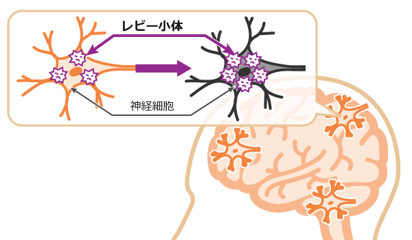 神経細胞とレビー小体のイメージ図